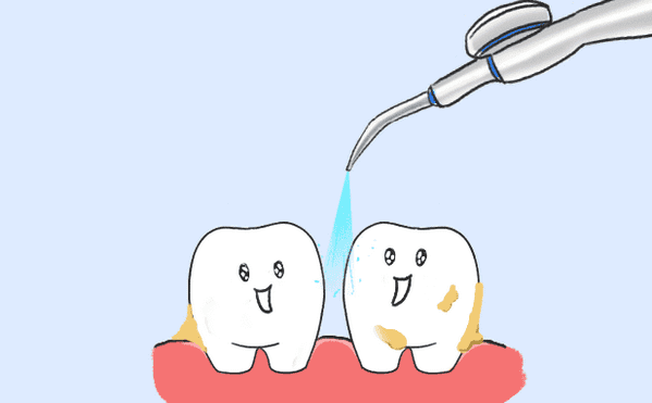 喷砂洁牙和抛光洁牙有什么区别，为什么洗牙要做喷砂和抛光