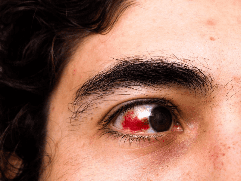 红眼病和结膜炎的区别