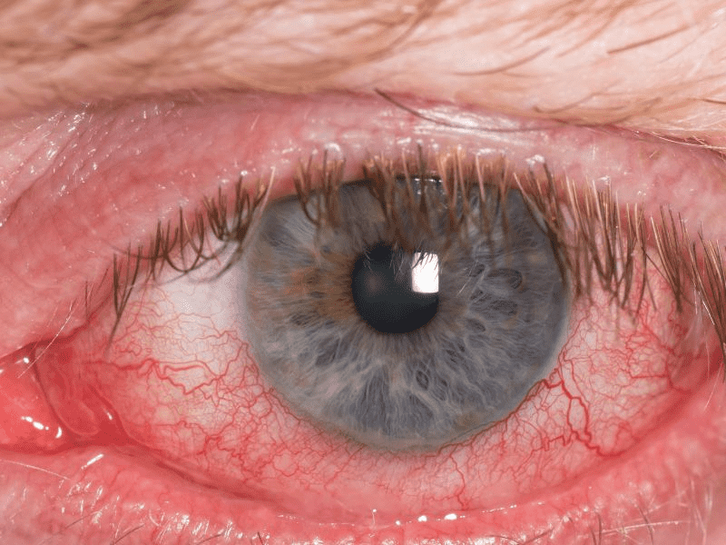 结膜炎和红眼病的区别