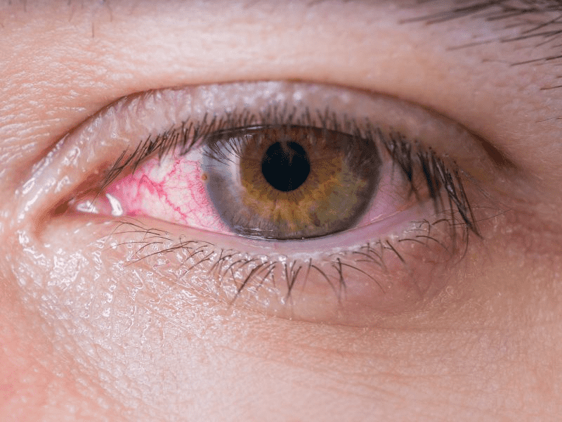 红眼病诊断