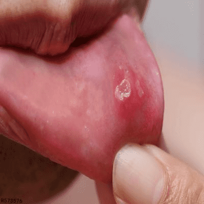 口腔里长水泡还有发烧是手足口病吗 手足口病的常见症状有5点